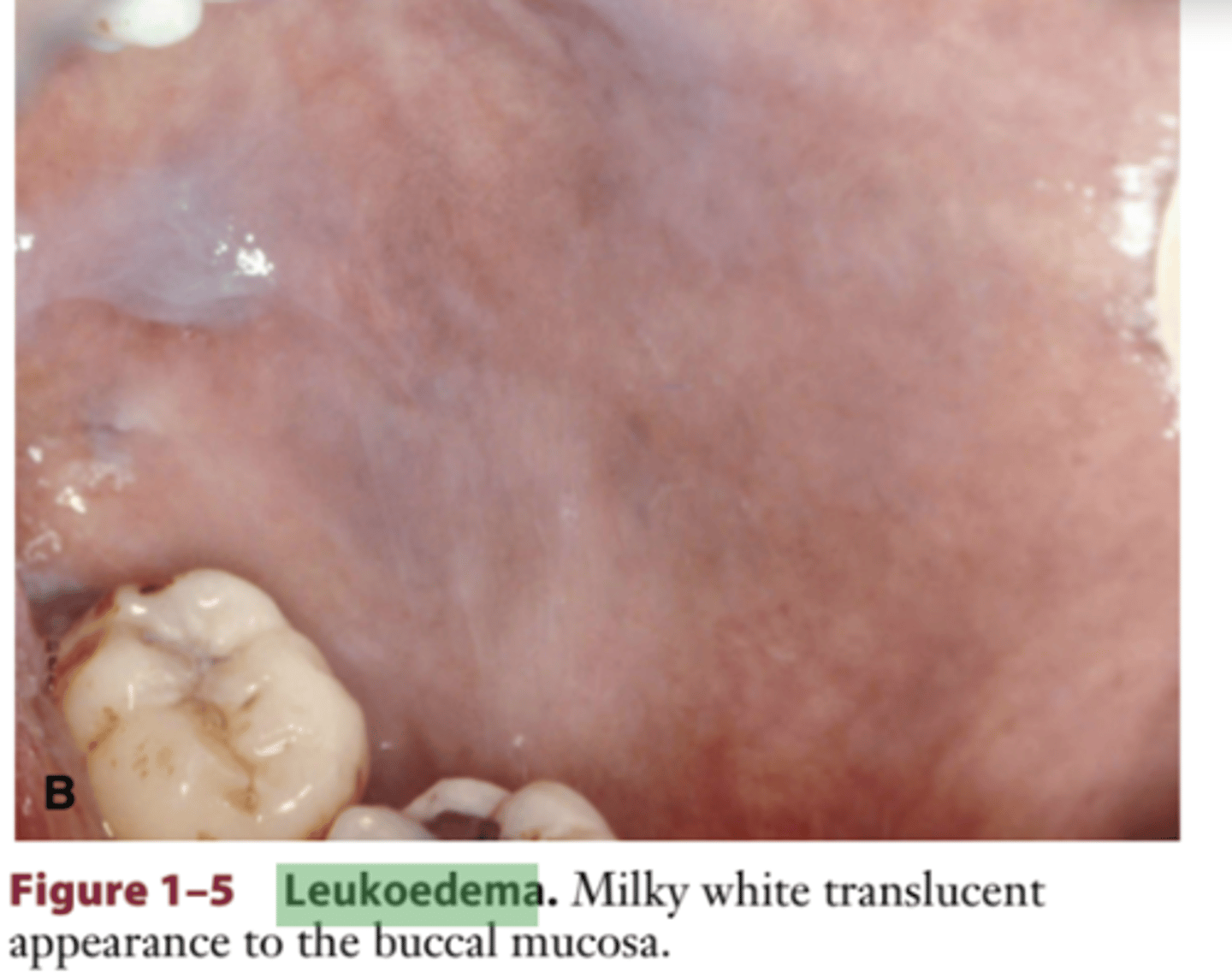 <p>generalized translucent or</p><p>opalescent covering, located over the buccal mu-</p><p>cosa</p><p>lesion initially appears</p><p>translucent white or opalescent and then disappears when the tissue is stretched</p><p>most common in BLACK individuals</p>