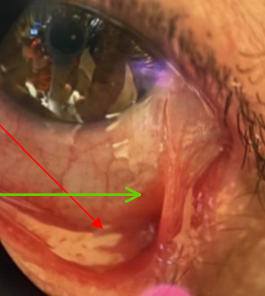 <p>Eyelash condition that can be misdiagnosed in early stages, until symblepharon forms</p><ul><li><p>F &gt; M, age 60+</p></li><li><p>Treat systemically and ocular involvement</p></li></ul><p></p>