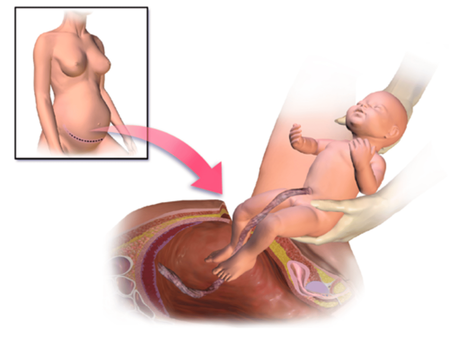 <p>Cesarean section rate 32% in the United States</p><p>Maternal Complications</p><p>Bowel and bladder injury during surgery,</p><p>Hemorrhage,</p><p>Amniotic fluid embolism</p><p>Infection</p><p>Neonatal complication</p><p>Respiratory distress</p>