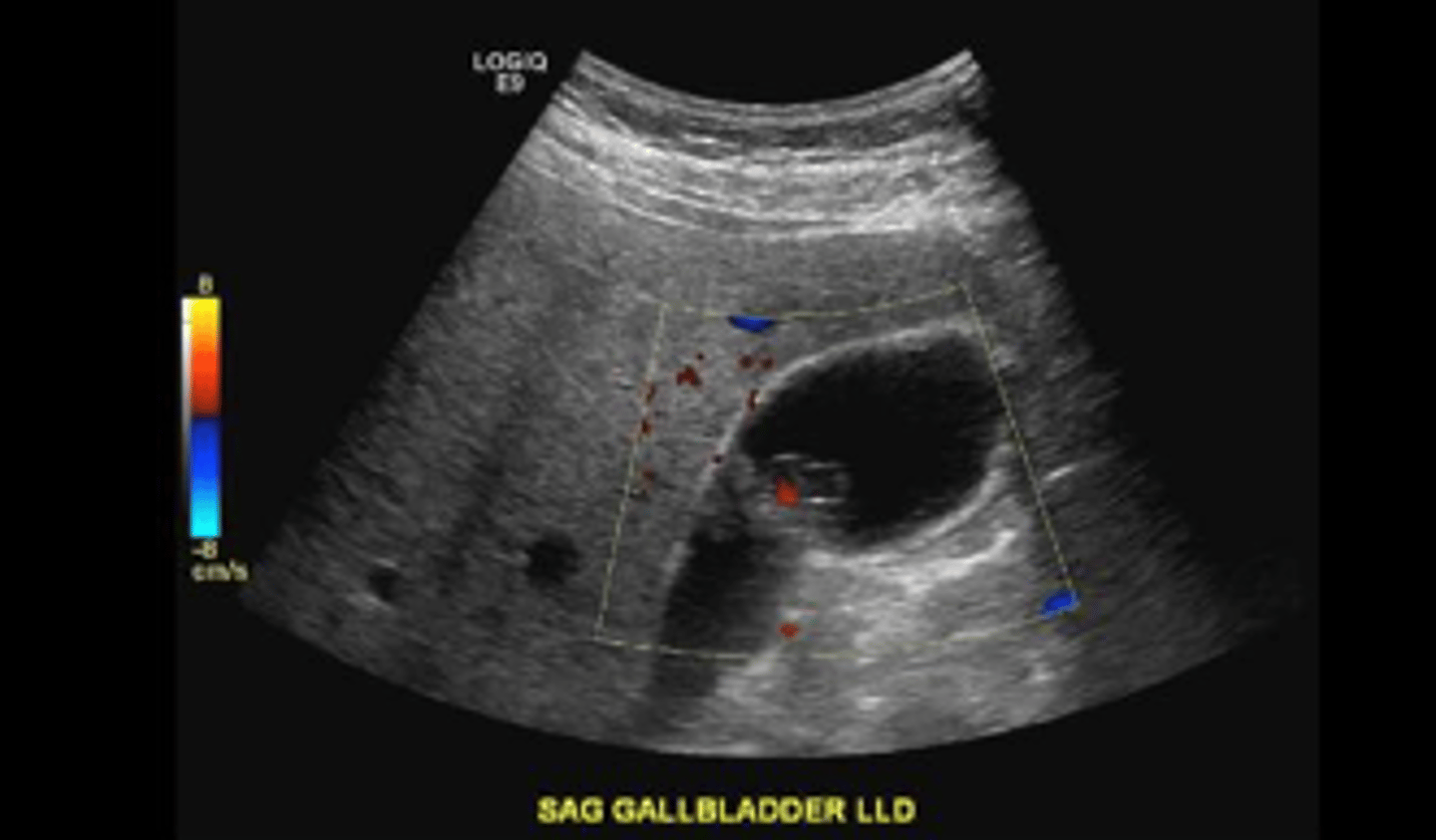 <p>Gallbladder metastasis</p>