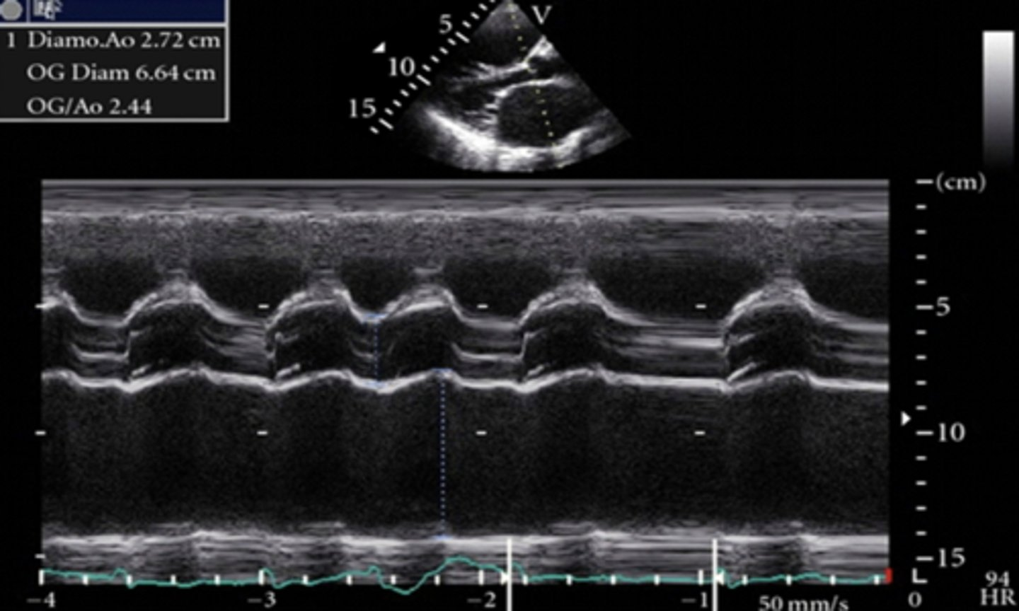 <p>larger than 1:1 ratio between LA and AOR with larger LA</p>