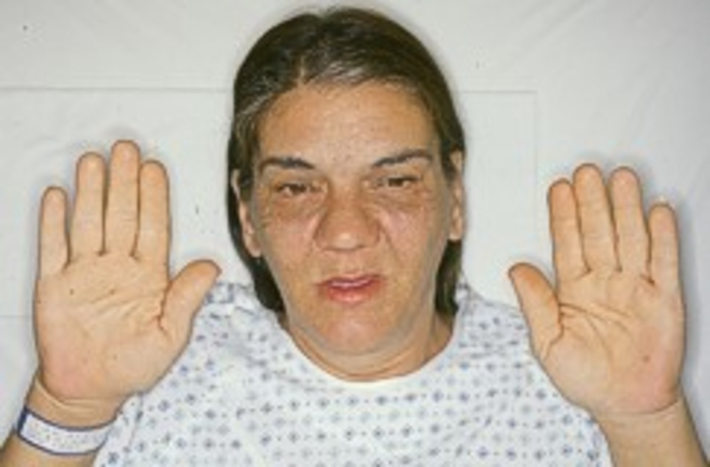 <p>Excessive secretion of growth hormone. face, hands, ad, and feet</p>