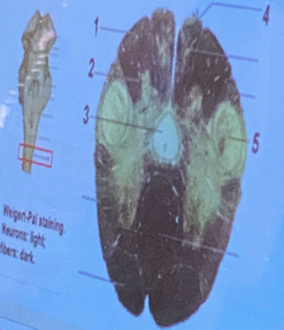<p>1.<span style="font-size: 7pt; font-family: Times New Roman">         </span>Gracile fascicle</p><p>Nucleus of trigeminal spinal tract</p><p>Cuneate fascicle </p>