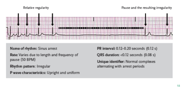 <p>a sinus rhythm resulting when the SA node does not initiate an impulse, causing pauses in the heart’s electrical activity; similar to sinoatrial block but with a greater time between complexes. Also called sinus pause</p><ul><li><p>Can be caused by SA node damage, medications, or increased vagal tone</p></li><li><p>The vagus nerve, which is part of the parasympathetic nervous system, controls vagal tone.</p></li><li><p>When the vagus nerve is stimulated the heart rate may slow.</p></li><li><p>Patients who are asymptomatic may not require treatment.</p></li><li><p>Medication may be prescribed for symptomatic patients</p></li></ul><p></p>
