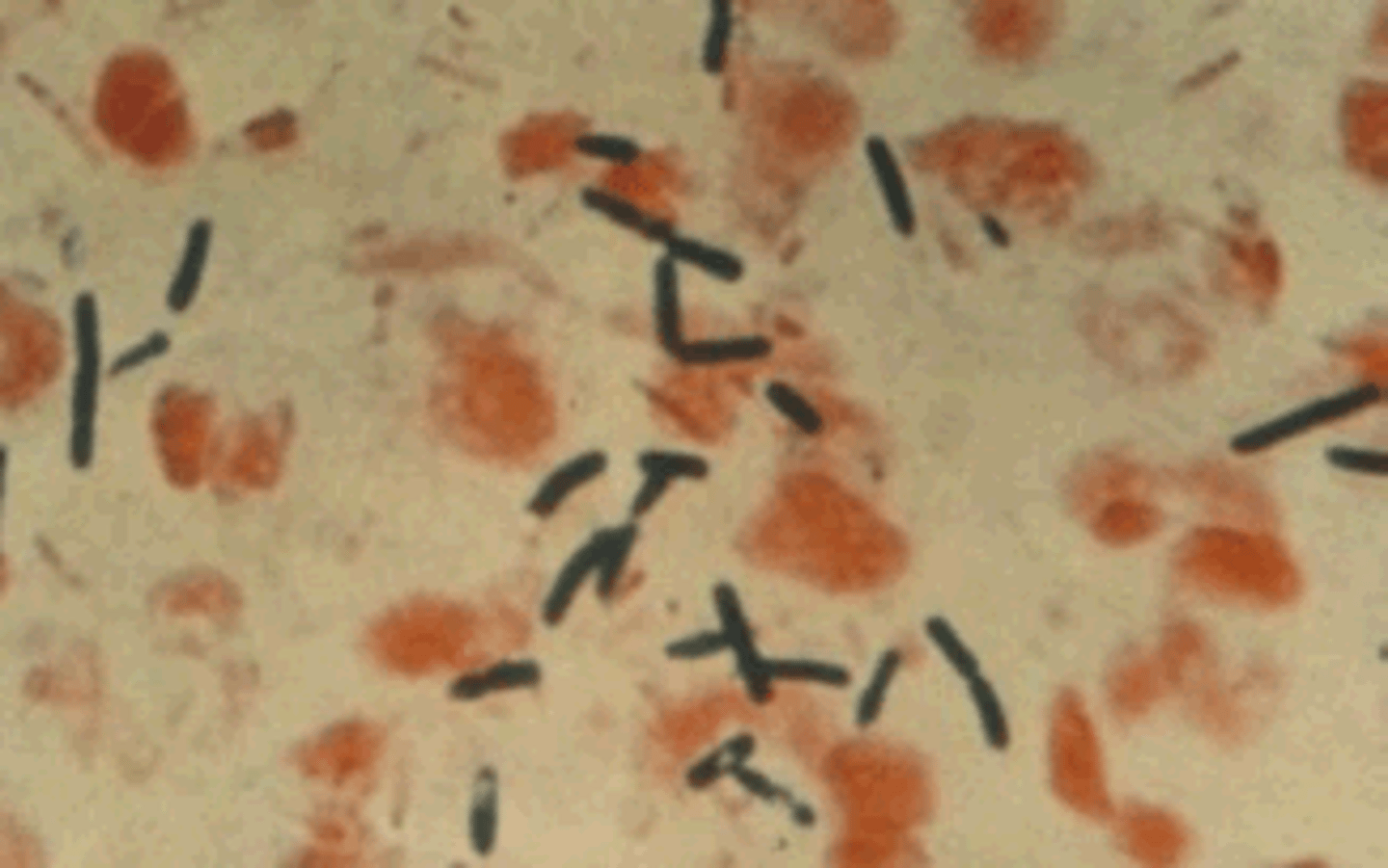 <p>Identify Pathogen causing Diarrhea:</p><p>Gram-positive, spore-forming, obligate anaerobic rod --&gt; Ingested enterotoxin</p><p>-Hx:</p><p>&gt; Meats/Poultry</p><p>&gt; Legumes</p><p>-Path: Incubation period (8-16 hrs); Heat resistant spores --&gt; Spores germinate, release enterotoxins</p><p>-Sx/PE: LATE ONSET</p><p>&gt; Secretory (Watery) Diarrhea</p><p>&gt; Abdominal Pain</p><p>&gt; Headache</p><p>-Dx:</p><p>&gt; Stool and/or Food Culture</p><p>&gt; Toxin Assay</p>