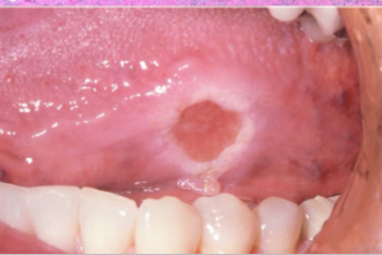 <p>deep chronic ulceration with slow resolution</p>
