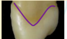 <p><mark data-color="green" style="background-color: green; color: inherit">maxillary canines #6 and #11; height of contour; facial</mark></p>