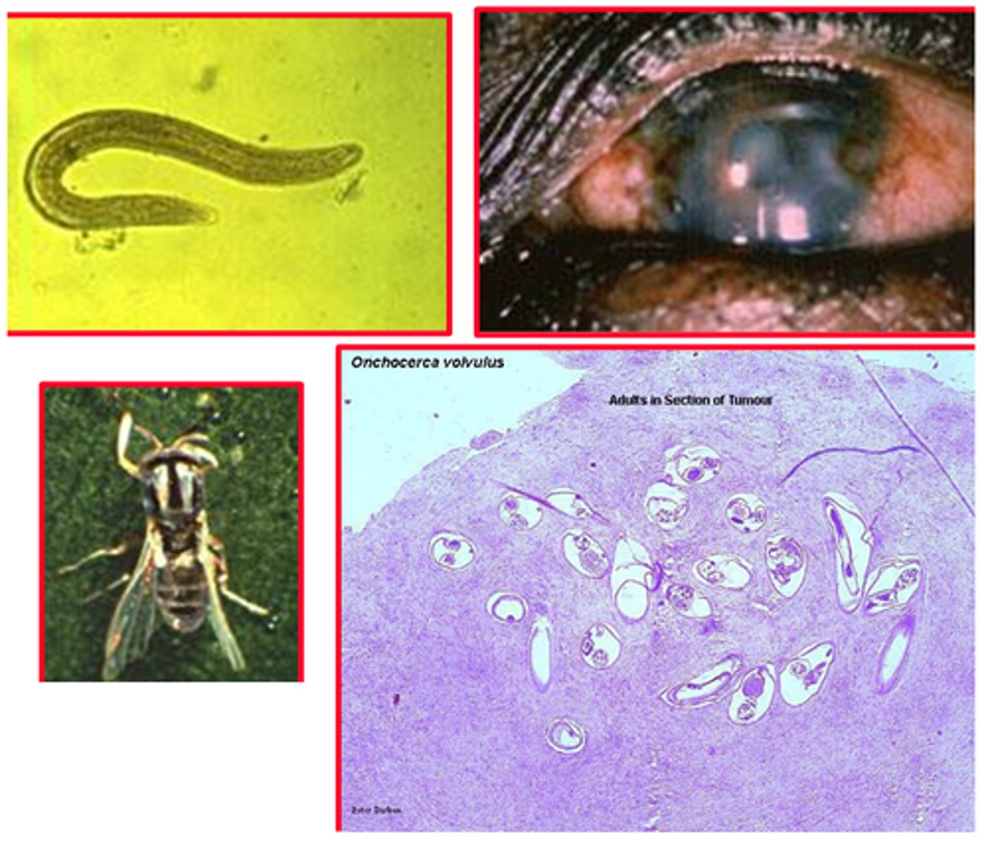 <p>- Infection by a nematode or roundworm, is transmitted to humans by the bite of black flies<br>- These worms spread through the body and can cause itching and eventual blindness</p>