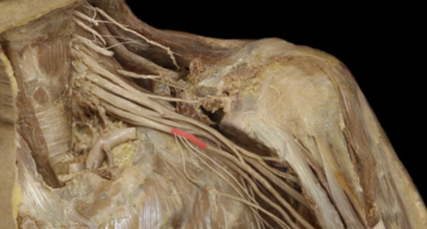 <p>formed by the anterior division of the lower trunk; C8-T1</p>