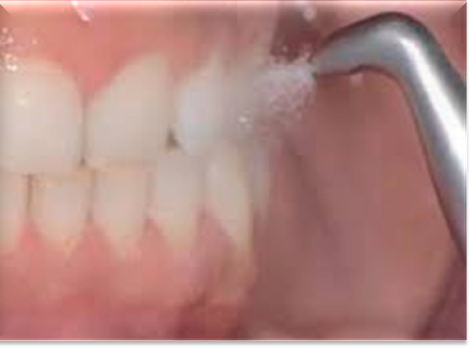 <p>What is the purpose of supragingival air polishing?</p>