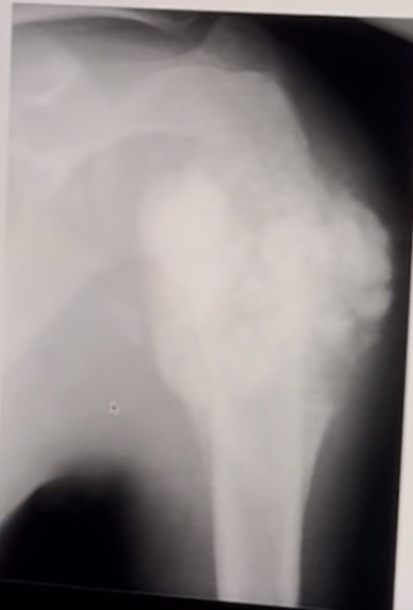 <p>ill defined, cortical destruction, Codman's triangle, aggressive appearing lesion</p><p>1 multiple choice option</p>