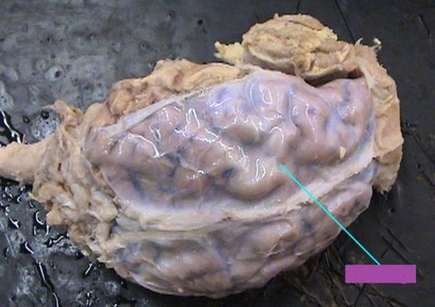 <p>thick, outermost layer of the meninges surrounding and protecting the brain and spinal cord</p>