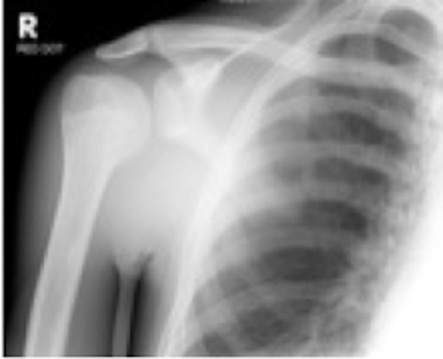 <p>light bulb sign (IR of humerus)</p><p>rim sign (>6mm joint widening)</p>