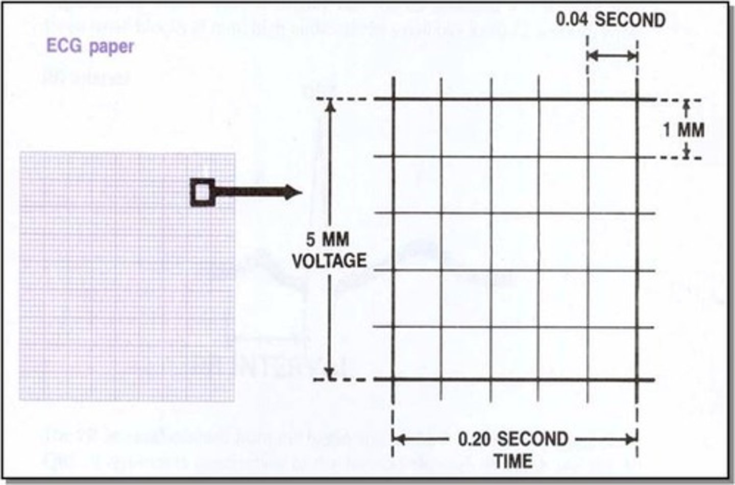 <p>First degree atrioventricular block is diagnosed when the PR interval is more than five small squares in the ECG</p>