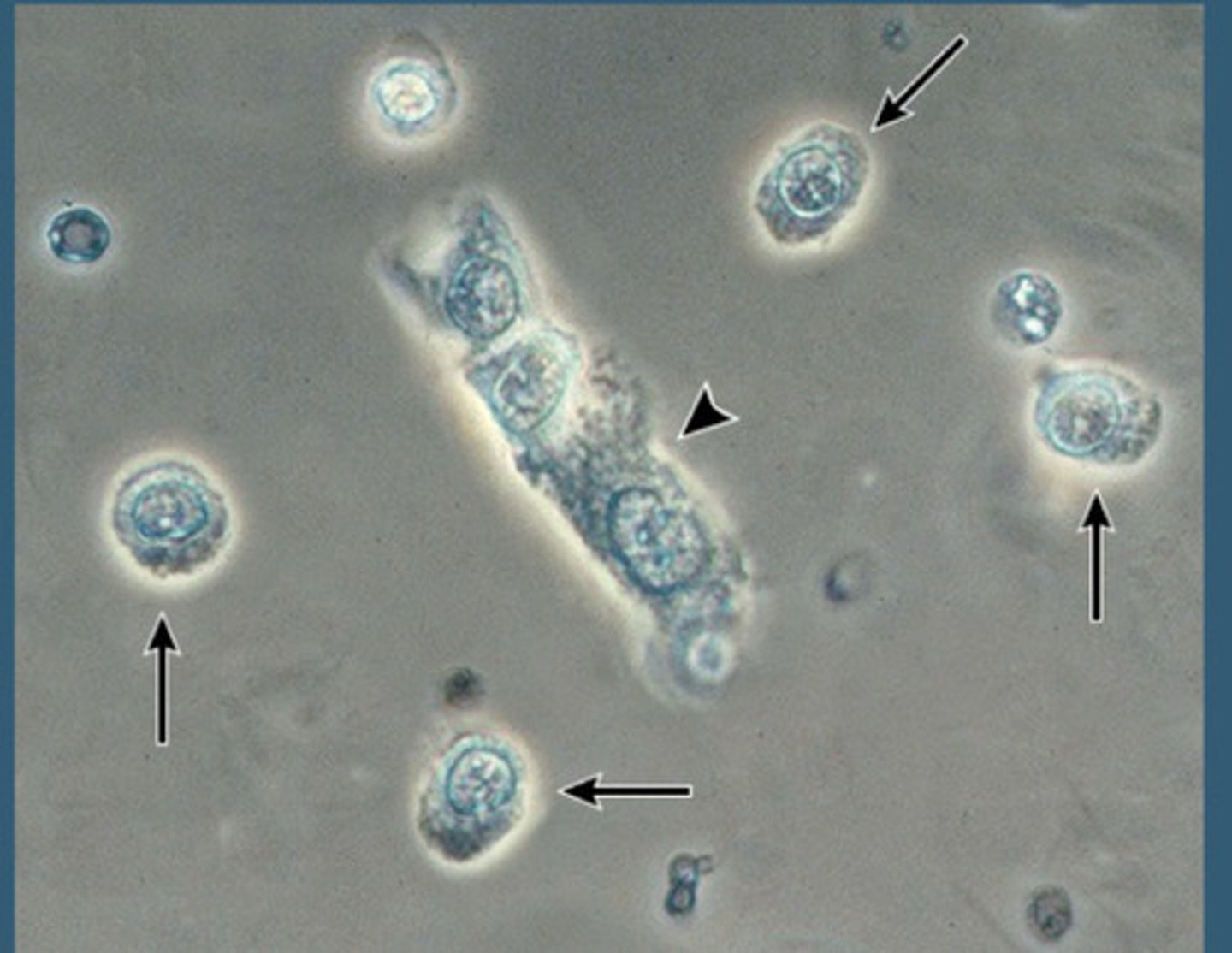 <p>Collection of Renal Tubular Epithelial Cells</p><p>Associated with Acute Tubular Necrosis (ATN)</p>