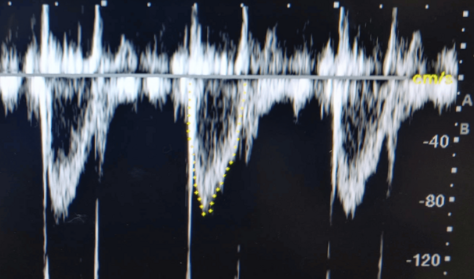 <p>Describe this trace in terms of:</p><ul><li><p>modality</p></li><li><p>quality of flow</p></li><li><p>peak velocity</p></li><li><p>shape of the flow</p></li><li><p>what is being measured</p></li></ul><p></p>