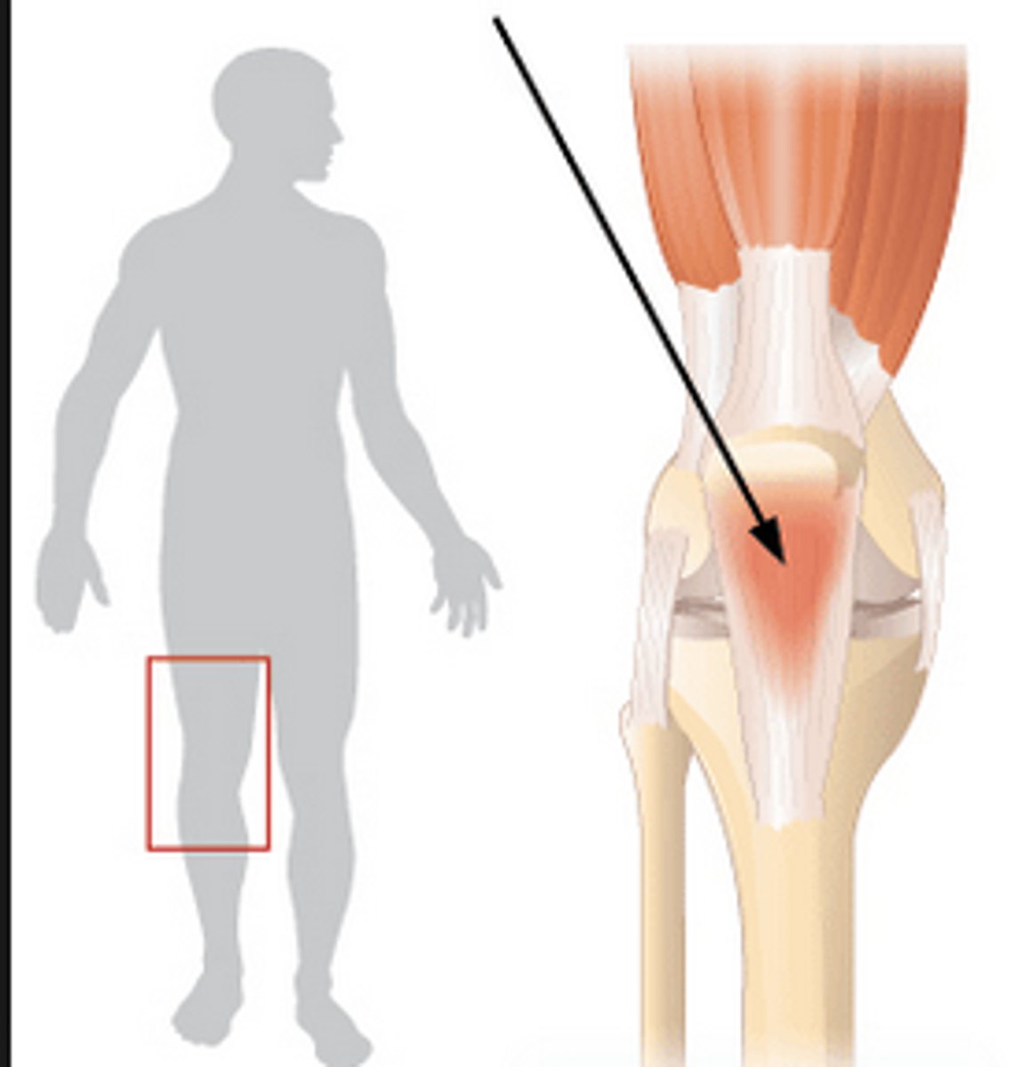 <p>A form of bursitis in which a tendon sheath is inflamed.</p>