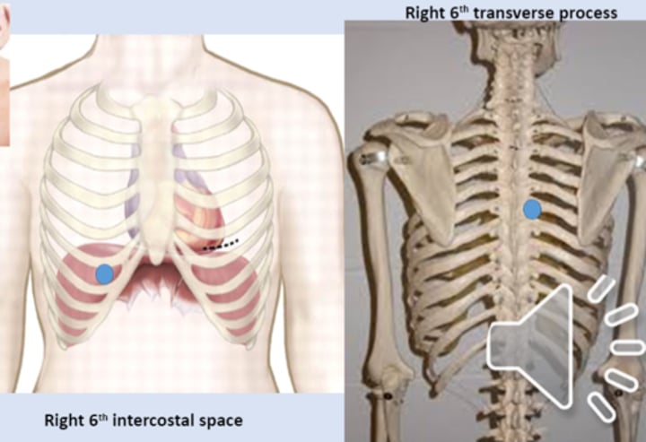 <p>anterior point: right medial 6th intercostal space<br>posterior point: right T6 transverse process</p>