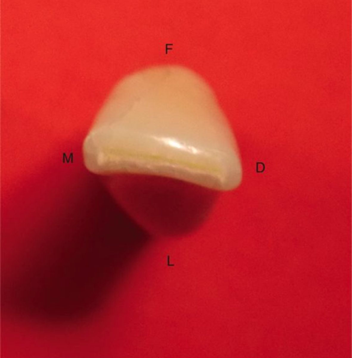 <p>crown is twisted distally on its root of the distal half of the incisal edge appears more lingual on MAND LATERAL</p>