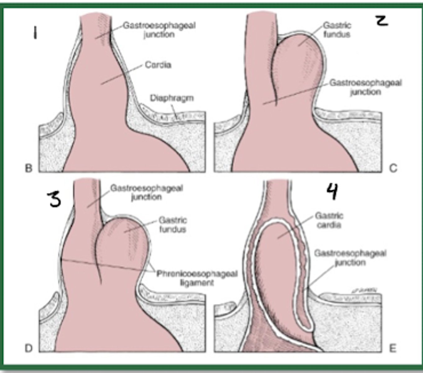 <p>•Type I = sliding hiatal hernia</p><p>•Types II, III and IV are all subtypes of paraesophageal hernias</p>