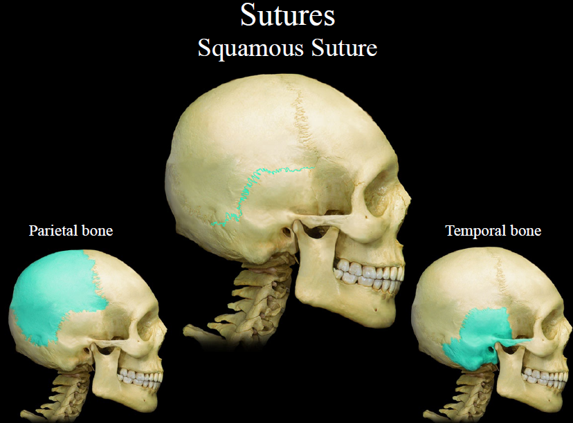 <p>suture between the parietal and temporal bones</p>