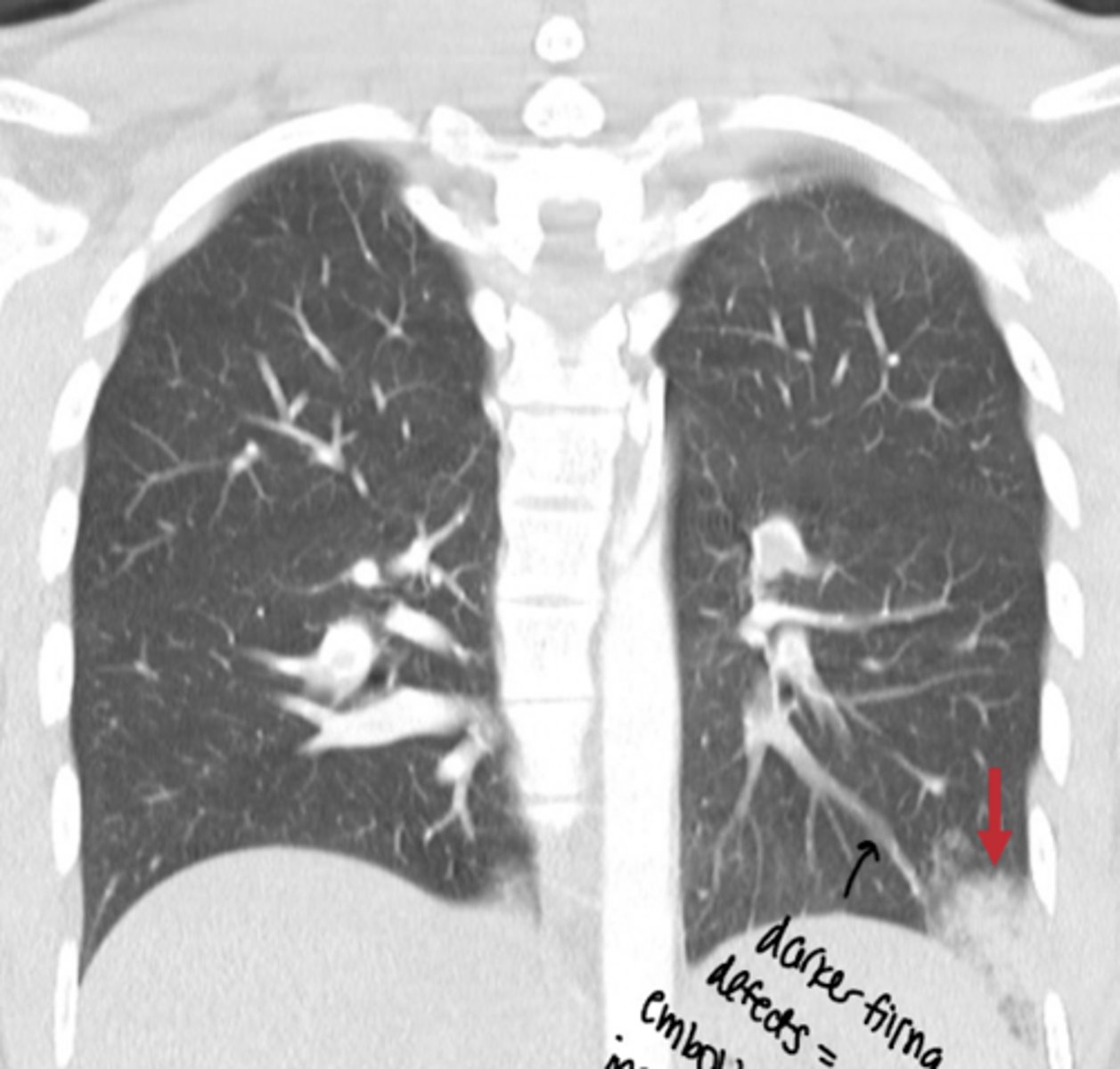 <p>Name the condition of this patient who had a recent pulmonary embolism</p>