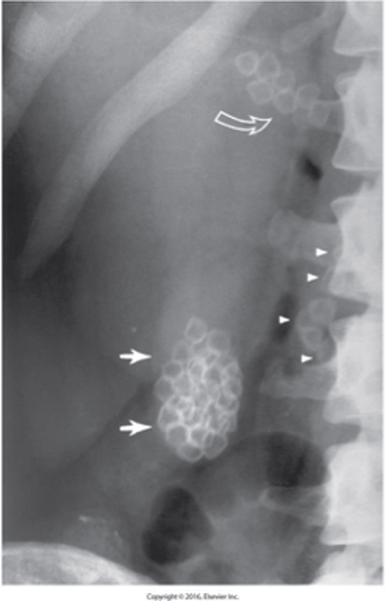 <p>What are the two major types of Gallstones (Cholelithiasis) ?</p>