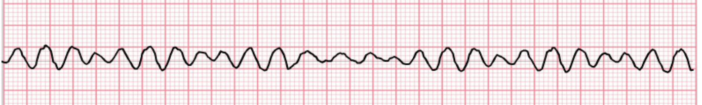 <ul><li><p>impulses originating from several places in ventricles at a high rate</p></li></ul><p></p>
