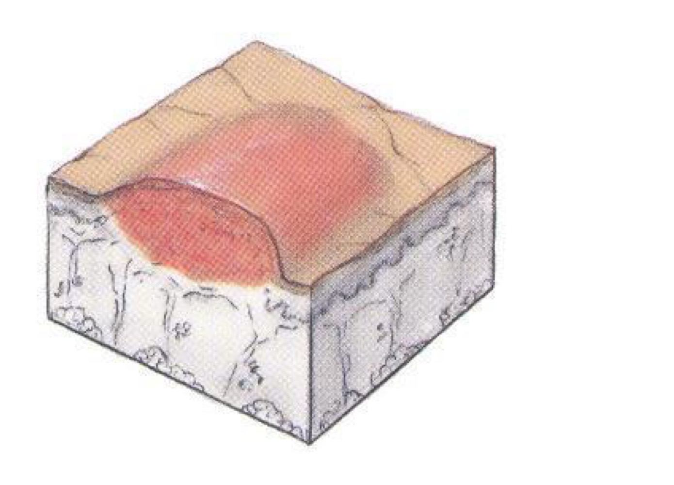 <p>what type of skin lesion is this? </p>