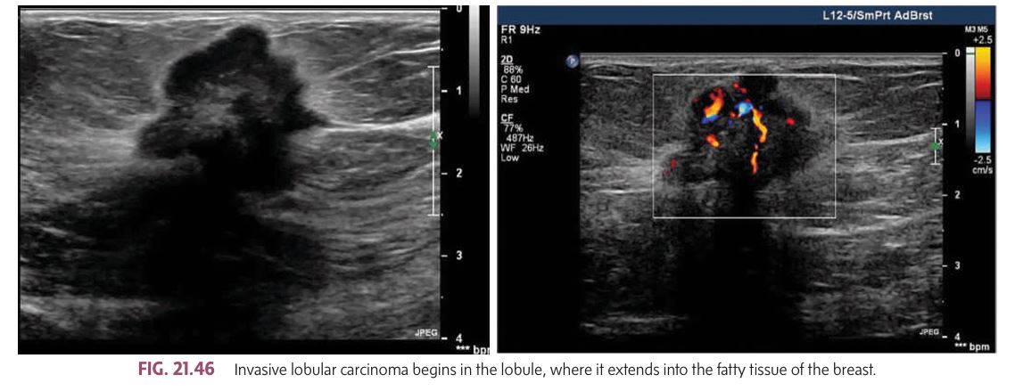 <p></p><ul><li><p class=""><strong><mark data-color="yellow" style="background-color: yellow; color: inherit">Second most common type of invasive tumor, accounting for 10% to 15% of all breast cancers.</mark></strong></p></li><li><p class=""> begins in the lobule of the breast and extends into the fatty tissue.</p></li><li><p class="">Similar to invasive ductal carcinoma (IDC), ____ has the potential to metastasize and spread to other parts of the body.</p></li></ul><p class=""><strong>Signs &amp; Symptoms</strong>:</p><ul><li><p class="">often be bilateral (affecting both breasts), multicentric (in multiple areas within the same breast), or multifocal (in multiple distinct locations).</p></li><li><p class="">Compared to IDC, this tends to have a more diffuse and less well-defined presentation.</p></li></ul><p class=""><strong>Prognosis</strong>:</p><ul><li><p class=""> poorer prognosis compared to invasive ductal carcinoma.</p></li><li><p class="">However, when the cancer remains localized to the breast, treated patients can have a 75% survival rate after 10 years.</p></li><li><p class="">represent 10% to 12% of all breast cancers.</p></li></ul><p class=""><strong>Associated Tumors</strong>:</p><ul><li><p class="">More favorable forms of include medullary, intracystic papillary, papillary, colloid, and tubular carcinomas.</p></li></ul><p></p>
