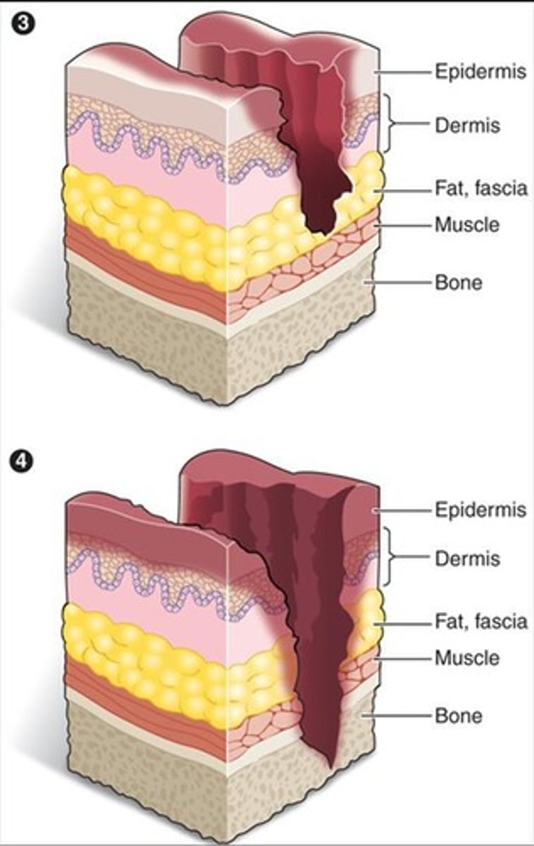 <p>Deterioration of layers deep to dermis.</p>