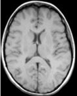 <p>28. The white “ring” seen around the brain in MRI imaging is </p><p>A. Bone </p><p>B. CSF </p><p>C. Fat </p><p>D. Air</p>