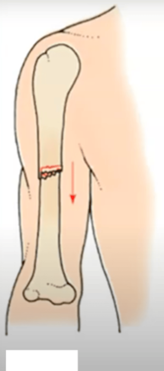 <p>fracture in which one bone fragment is pushed into another</p>