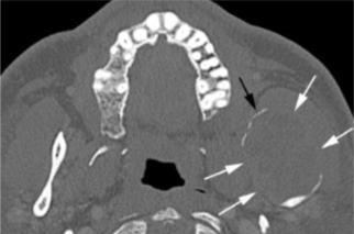 <p>new formation and cortex lost (eroded); suggests malignancy </p>