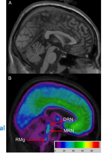 <p>Serotonin → supported by efficacy of SSRIs</p><p></p><p>Raphe is site of 2 major nuclei.<br><br>MRN → limbic/prefrontal cortex → mediates fear/anxiety.</p><p></p><p>DRN → Prefrontal cortex, basal ganglia, PAG → Modulates cognitive/behavioural components.</p>