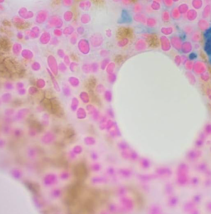 <p>Prussian blue stains iron stores; what would you report this iron store 0-4+? </p>