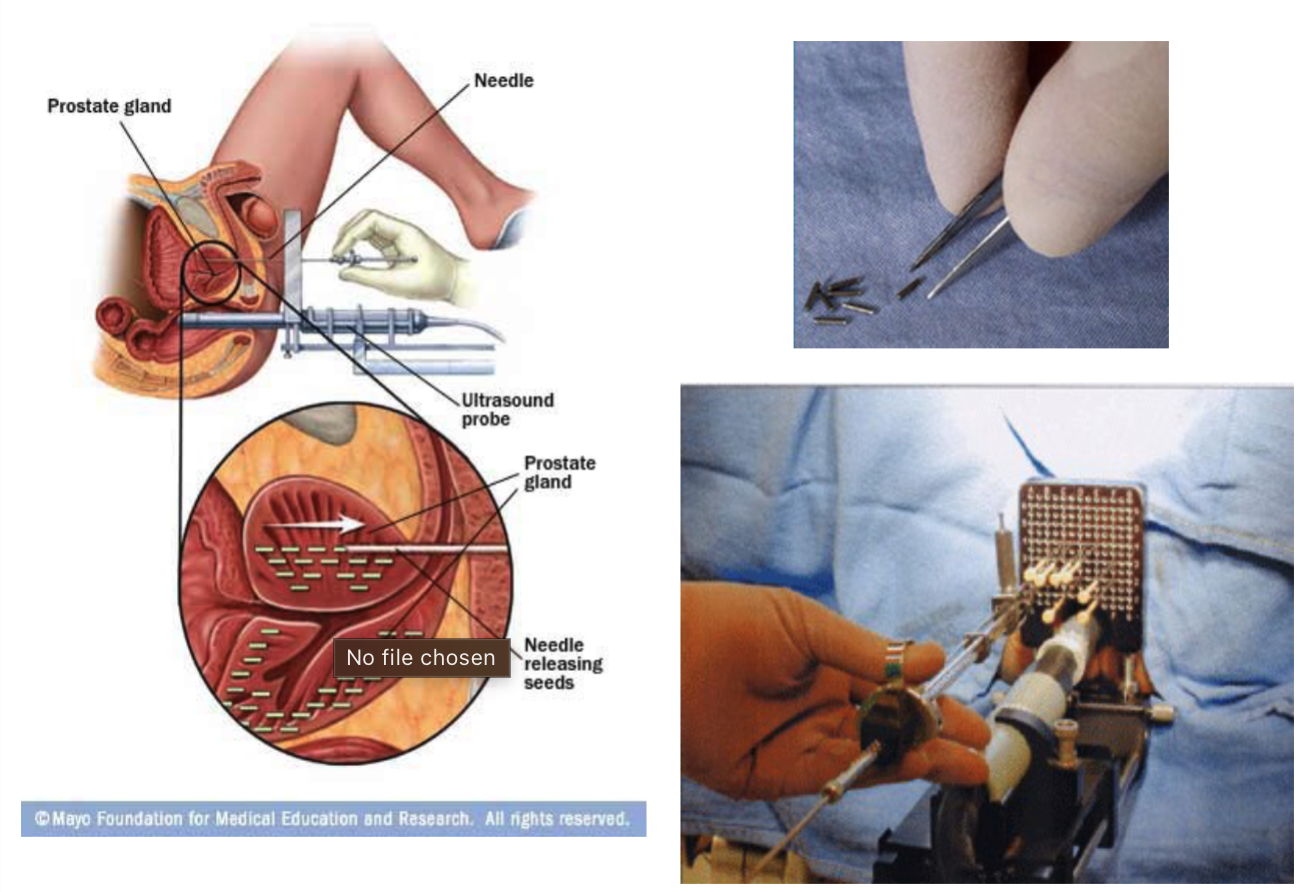 <p>Tiny radioactive seeds implanted directly into the prostate, delivering continuous low-dose radiation over time.</p>
