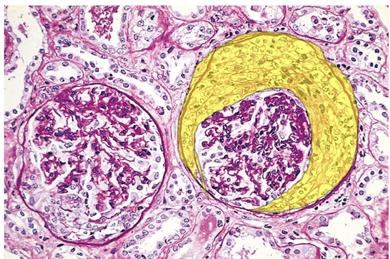 <p><em>type of nephritic syndrome</em>: glomerular disease with crescent formation and rapid renal decline<br><em>started by either</em>:<br>1) Immune complexes in glomerulus promoting inflammation<br>2) Anti-GBM antibodies (IgG) stimulate inflammation<br>– Inflammation → <mark data-color="#d7ff00" style="background-color: #d7ff00; color: inherit">proliferation of Bowman’s capsule cells</mark> <span data-name="crescent_moon" data-type="emoji">🌙</span> + leukocyte infiltration → crescents obliterate Bowman’s space<br>– <em>presents w nephritic syndrome symptoms</em></p>