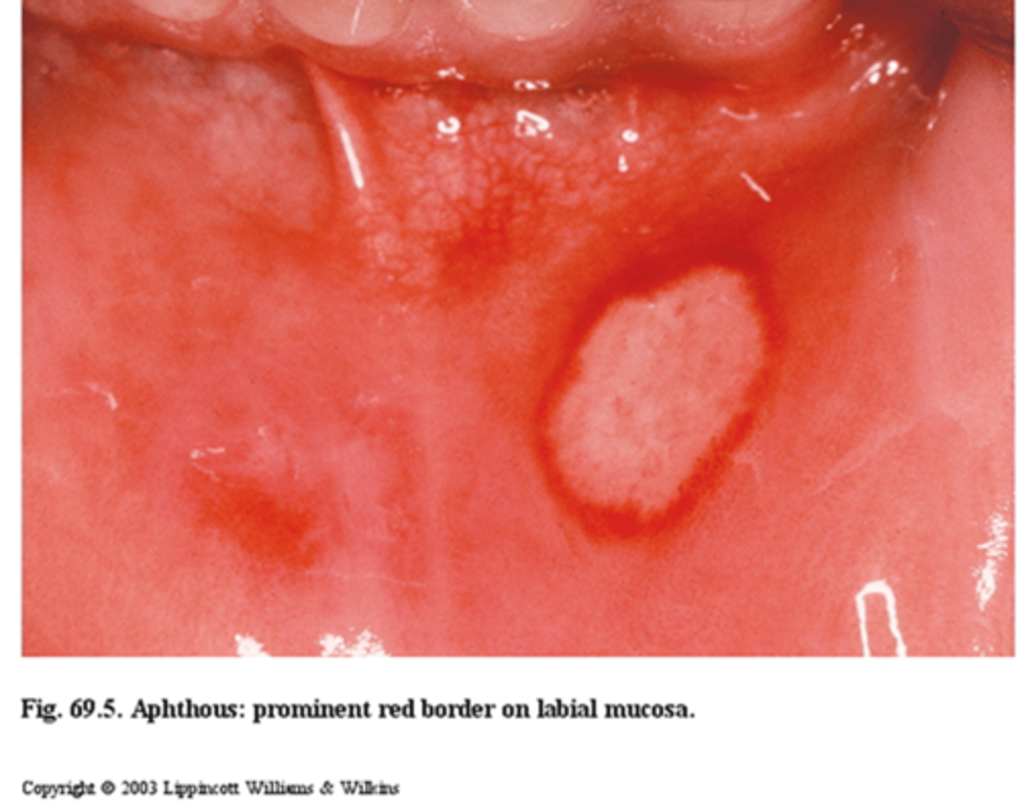 <p>1-3cm ulcer</p><p>• larger than aphthous minor </p><p>• common locations: labial mucosa, soft palate</p><p>• scarring </p>