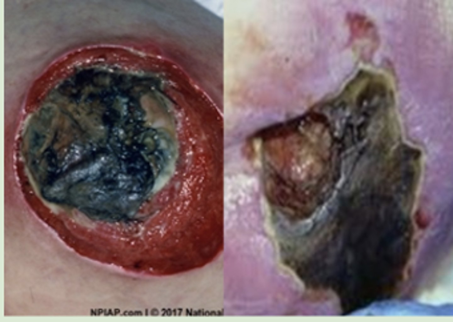 <p>Unstageable Pressure Injury</p>