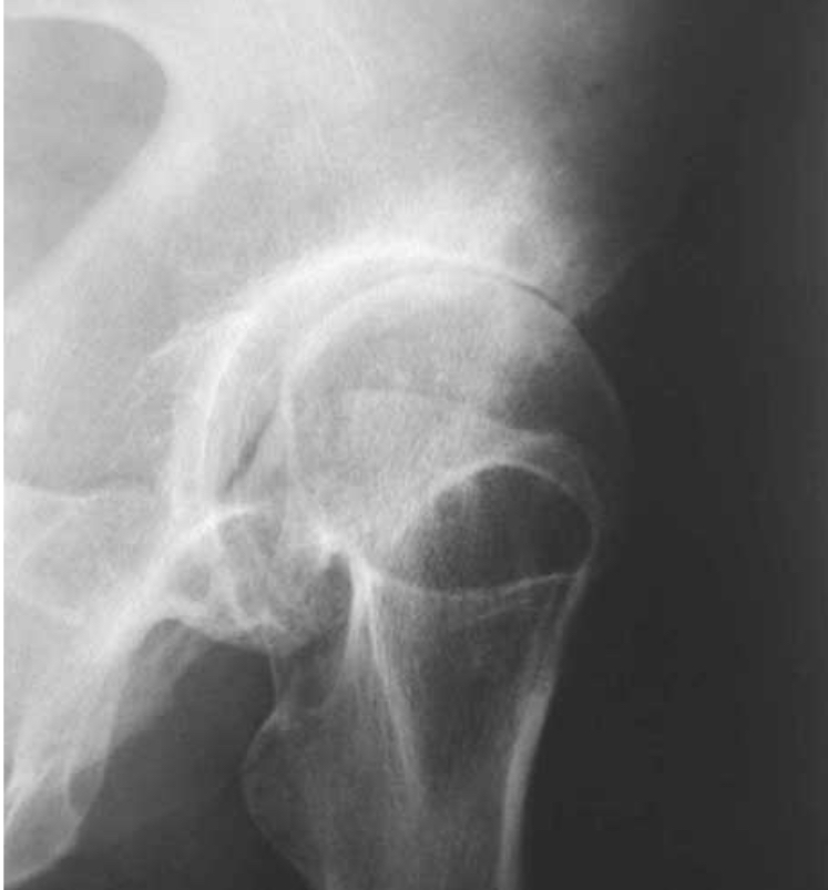 <p>= maladie ostéo-articulaire : atteinte des 4 tissus composant l’articulation synoviale = cartilage articulaire, os sous-chondral, membrane synoviale et capsule -> coxarthose, gonarthrose, arthrose digitale…</p><p>=> POGO :</p><p>- pincement de l’interligne articulaire</p><p>- ostéocondensation sous-chondrale</p><p>- géodes sous-chondrales</p><p>- ostéophytose marginale</p><p></p><p>Diag par radio, scanner, IRM</p>