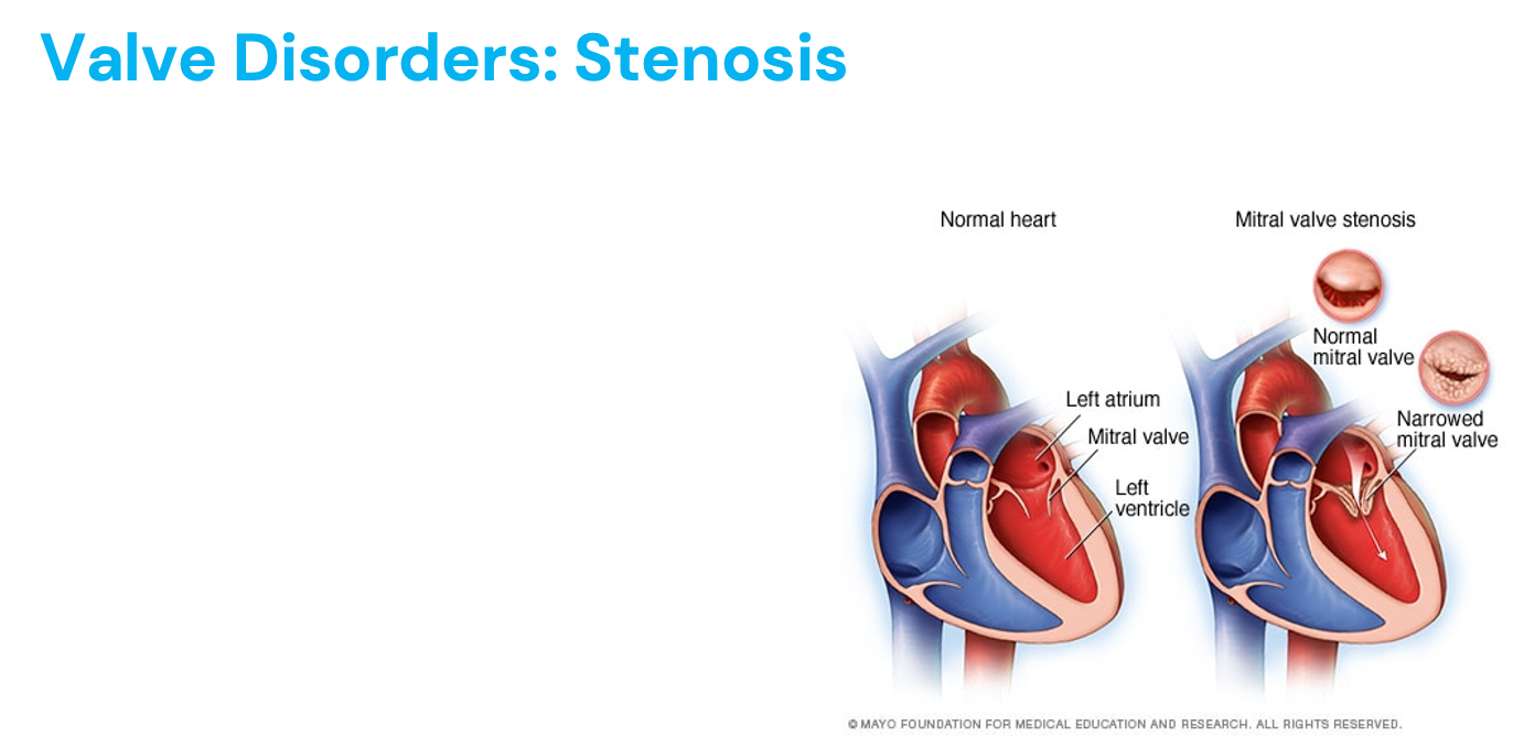 <ul><li><p>Aortic and mitral valve most common</p><ul><li><p>On same side of heart (left) = muscular, more friction, force, wear and tear</p></li><li><p>Scar from rheumatic fever (from untreated strep throat) - can destroy valves</p></li><li><p>Wear and tear</p></li><li><p>Congenital anomalies - babies born with heart abnormalities&nbsp;</p></li></ul></li><li><p>Valve doesn’t open completely</p></li><li><p>Tricuspid valve disorders - drug abuse (first that blood encouters, unproper use of needles)</p></li><li><p>Young women - mitral valve regurgitation&nbsp;</p></li><li><p>High pressure - treatment&nbsp;</p></li><li><p><mark data-color="yellow" style="background-color: yellow; color: inherit;">Where does blood back up into? What would these patients present with?</mark></p><ul><li><p>Aortic stenosis = left ventricle, LV ESV increased (afterload increased), chest pain, fatigue, syncope, dyspnea (no pulmonary edema), can eventually cause LVH</p></li><li><p>Mitral stenosis = left atrium, EDV decreased (preload decreased), can cause pulmonary congestion</p></li><li><p>Pulomonic stenosis = right ventricle, EV EDV increased (RV afterload increased), can cause RVH</p><ul><li><p>Would this increase or decrease blood flow to the lung?</p></li><li><p>What would happen to LV preload?</p></li></ul></li><li><p>Tricuspid stenosis = right ventricle, RV ESV increased, abdominal distention, fluttering discomfort in the neck (why??)</p></li></ul></li></ul><p></p>