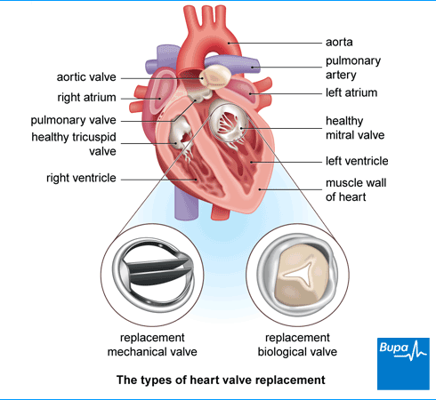 <p>Valve replacement surgery</p>