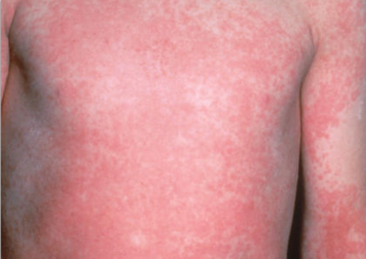 <p>etythrogenic toxin</p>