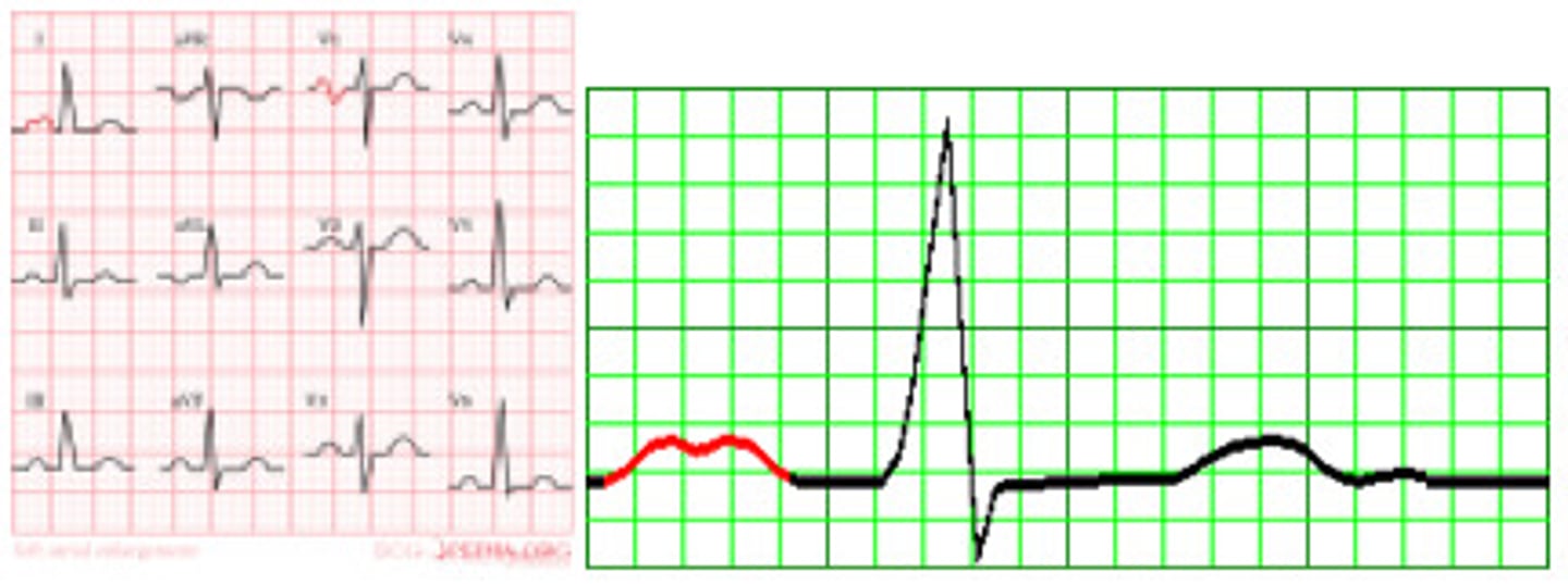 <p>I --&gt; wide P wave (biphasic)</p><p>V1 --&gt; P wave up &amp; down like an S (terminal negativity)</p>