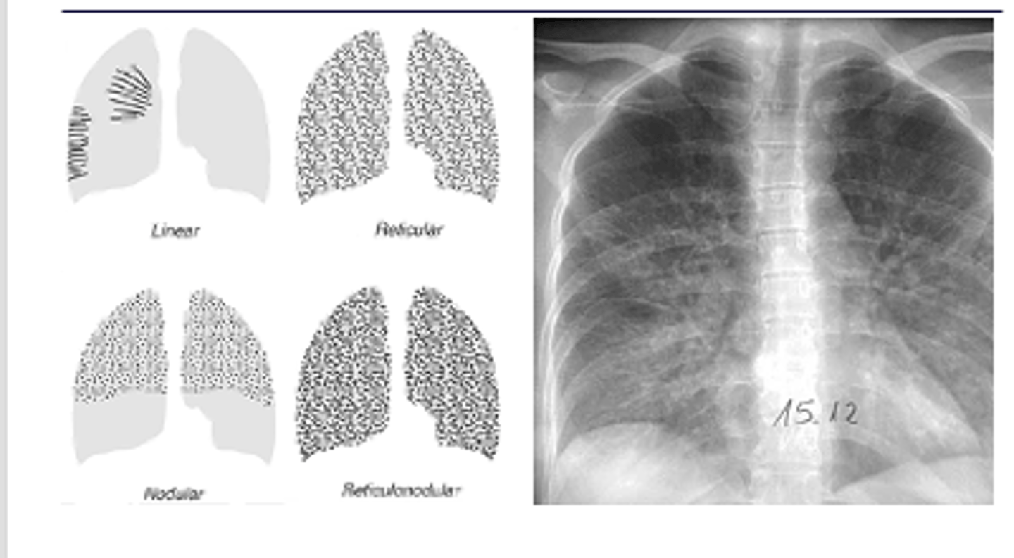 <p>caused by acute and chronic disease processes that affect the tissue outside of the alveoli.</p><p>Interstitial processes are usually diffuse &amp; are seen as thin white lines. May appear honeycombed (reticular)</p><p>Interstitial infiltrates are nonspecific as they can be caused by many processes such as CHF, pulmonary fibrosis, collagen vascular diseases, etc.</p>