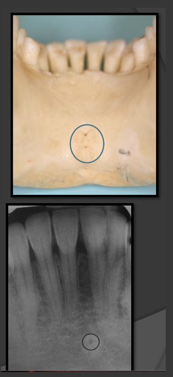 <p>Presents as a tiny radiolucent dot below the mandibular centrals. Looks like a white donut because it is overlapping with the genial tubercle.</p>