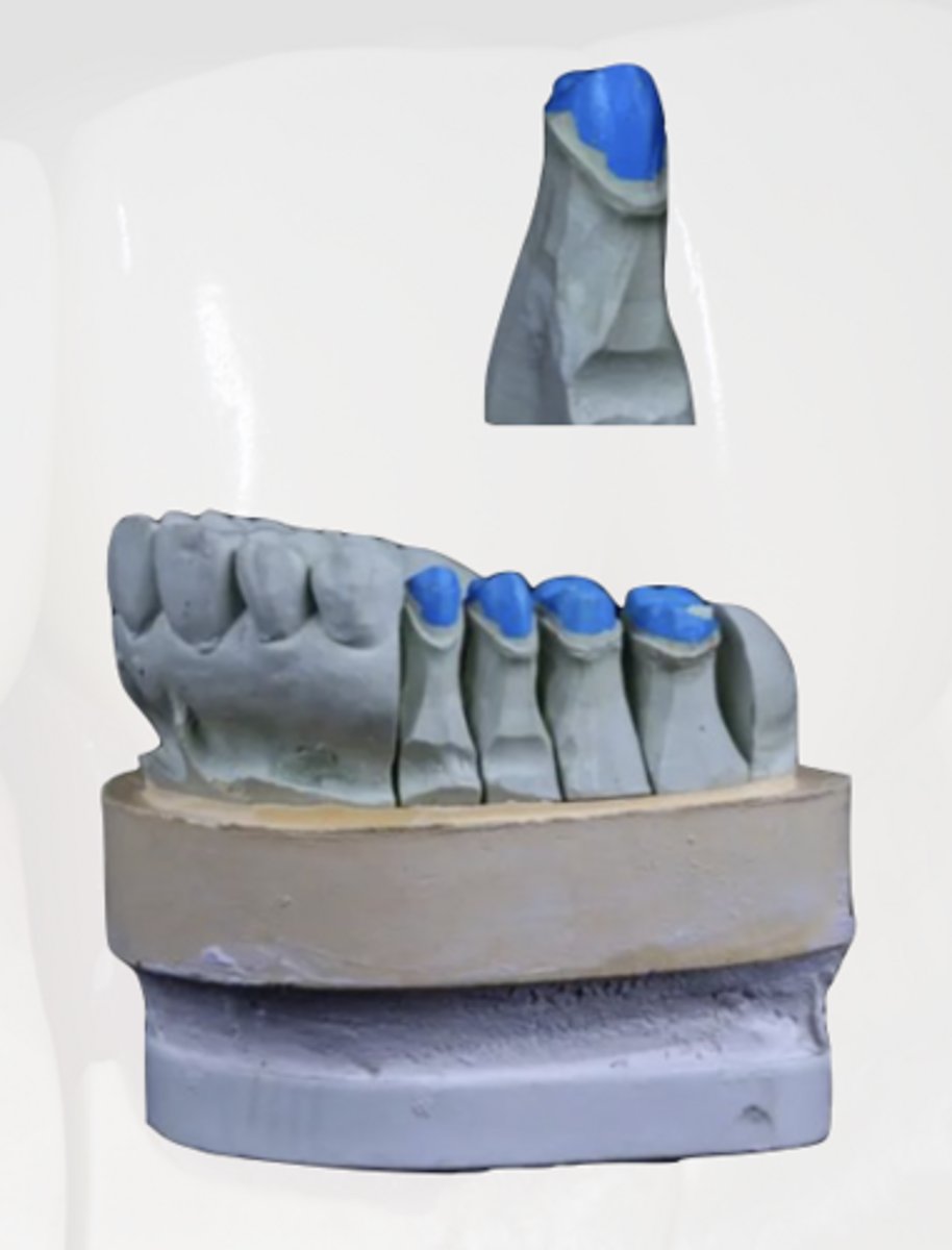 <p>All of the following are requirements for a good casts EXCEPT:</p><p>A) Exact reproduction of both prepared and unprepared tooth surfaces</p><p>B) Free of voids and bubbles, especially along the finish lines of the prepared teeth</p><p>C) Should include all relevant soft tissues including all edentulous spaces and residual ridges. </p><p>D) Certain portions of the cast must be distortion free</p><p>E) The Cast and the Die must be trimmed to ensure access for carving the wax pattern along the margins</p>
