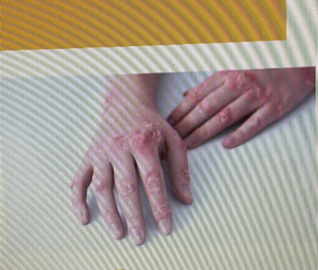 <p>eczema</p>