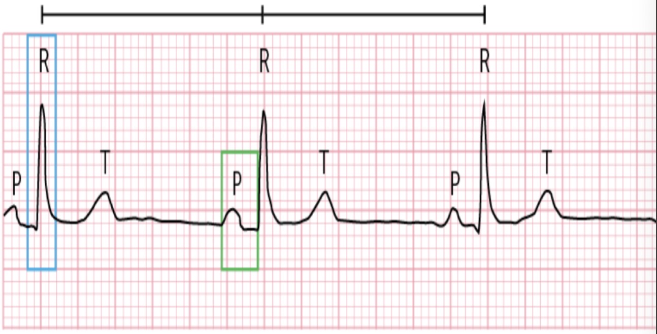 <p>Sinus Bradycardia</p>